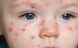 chickenpox