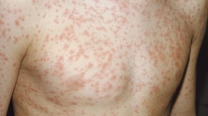 Rubella rash